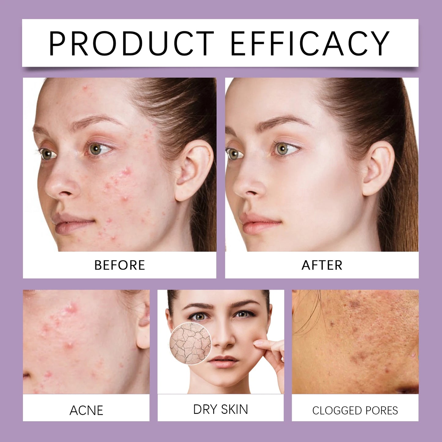 Berry Scented Blemish Lotion Care Facial Moisturizer Reduce Breakouts & Tighten Skin Non-Comedogenic Hydrator Clear Glowing